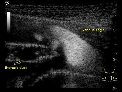 Ultrasound Imaging of the Thoracic Duct