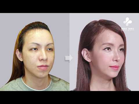 Dr. Adrian M. Hsieh｜FFS （Facial Feminization Surgery）