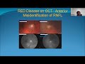 Recent Diagnostics In Glaucoma