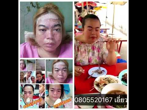 กลากเป็นโรคที่ ในการรักษาโรคสะเก็ดเงินอับ