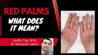 Red Palms: What does it Mean?