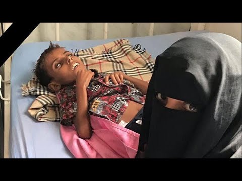 اليمن بعد أمل حسين.. آدم علي يقضي بسبب سوء التغذية ونعي أممي "إلى جنات الخلد يا آدم"…