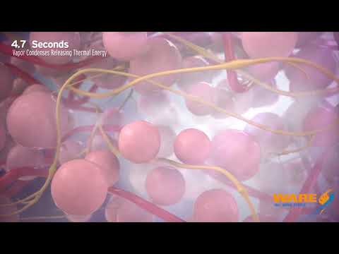 Medizinische Unterwäsche für Prostatitis In Prostata-Saft Staphylococcus epidermidis
