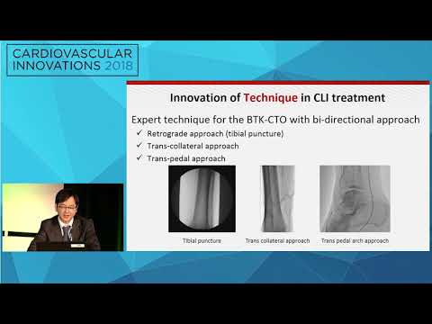 CVI2018 Session: Innovation in CLI Treatment