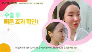 시술 직후 바로 효과확인! 실리프팅하면 압…
