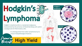 Hodgkin Lymphoma | Hodgkin’s lymphoma | Hodgkin’s Disease | Reed-Sternberg Cell | Pathology