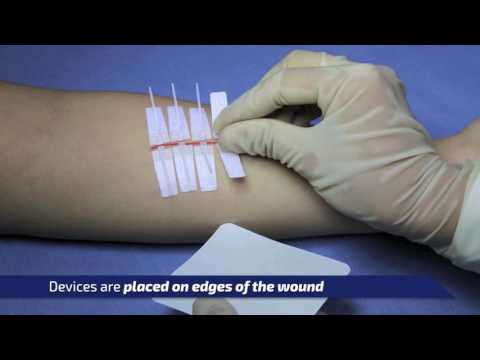 DermaClip: Basic Overview, a Non-Invasive Wound Closure Device