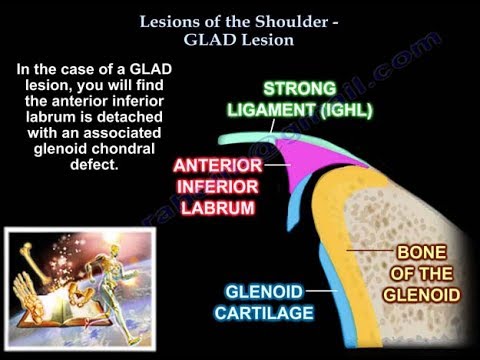 Lesions Of The Shoulder GLAD Lesion - Everything You Need To Know - Dr. Nabil Ebraheim