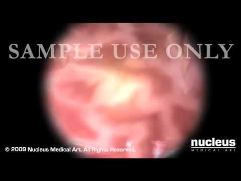 Percutaneous Endoscopic Gastrostomy PEG Feeding Tube Placement