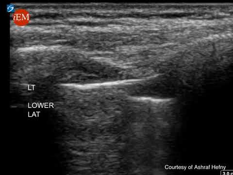 Pneumothorax - ultrasound -  Lung Point