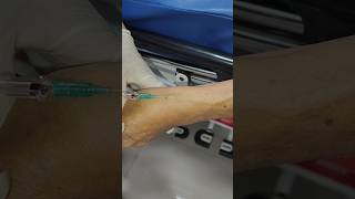 Download lagu Pasang Infus dengan Abocath 18 | IV Insertion Using Abocath 18G mp3