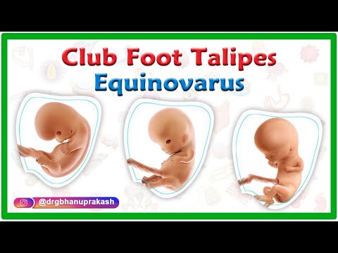 Club foot / Talipes equinovarus : Causes, Symptoms, Diagnosis and Treatment