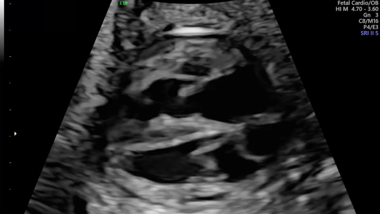 ECOCARDIOGRAFIA FETAL EM GESTAÇÃO DE 32 SEMANAS