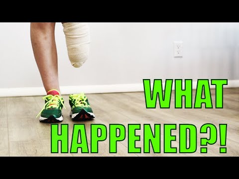WHAT HAPPENED?! My Story of How I Lost My Leg and Became an Amputee