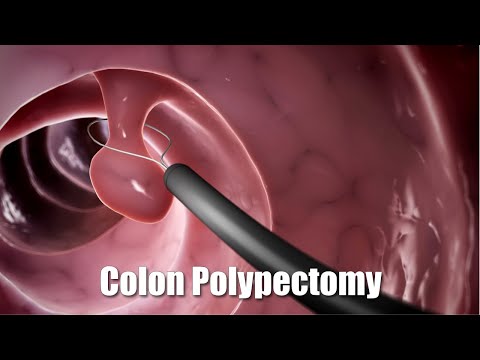 Removing a polyp from the colon (3D Animation)