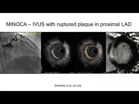 Algorithm for evaluation of the MINOCA patient - Yader Sandoval, MD
