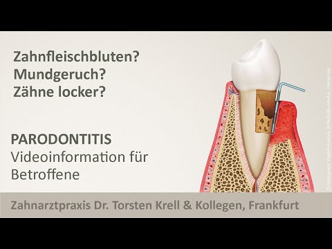 Parodontitis-Behandlung Zahnarzt Frankfurt - Dr. Torsten Krell & Kollegen