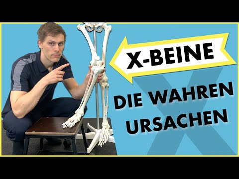 X Beine - Das ist die wahre Ursache!