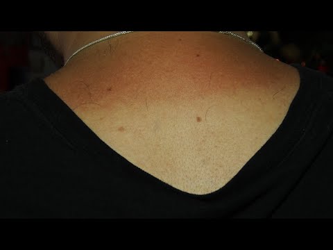 Pele sob o sol da serra também merece atenção e cuidado para evitar câncer