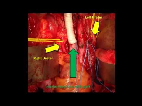 RPLND With IVC Thrombectomy & Caval Resection - Testicular Cancer Surgery 