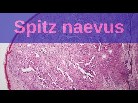 Spitz Naevus - Pathology mini tutorial
