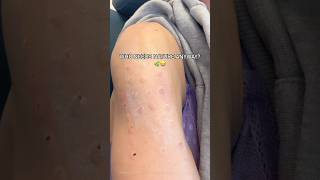 How to test for allergies  #allergal #allergies #skin #testing #virginia