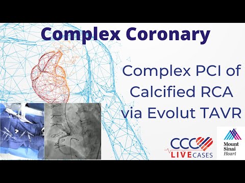 PCI of LM and LCx using Rotational Atherectomy - CCC Live Cases October 2017