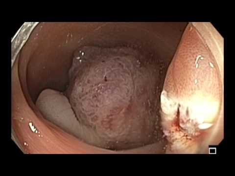 Colonoscopia - colon sigmoide estrecho - resección de pólipo pediculado grande 