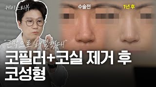 “코실·코필러 제거 + 복코 개선” 무보형물 코성형 1년 경과 | 외국인 환자 콧대 전체근막 교정 케이스리뷰