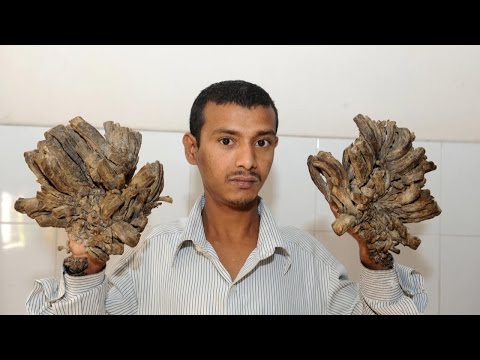 Surgeries Give “Tree Man” His Life Back