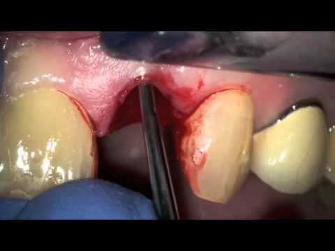 Usunięcie złamanego zęba przy pomocy periotomu, zabezpieczenie mostem adhezyjnym
