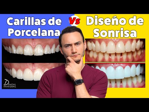 Dental Veneers vs. Smile Design | What you need to know before deciding