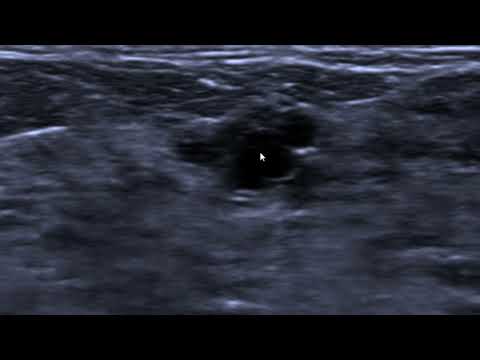 Microcistos agrupados na ultrassonografia da mama