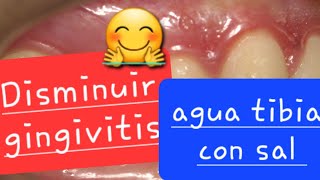 Disminuir la gingivitis con enjuagues de agua tibia con sal
