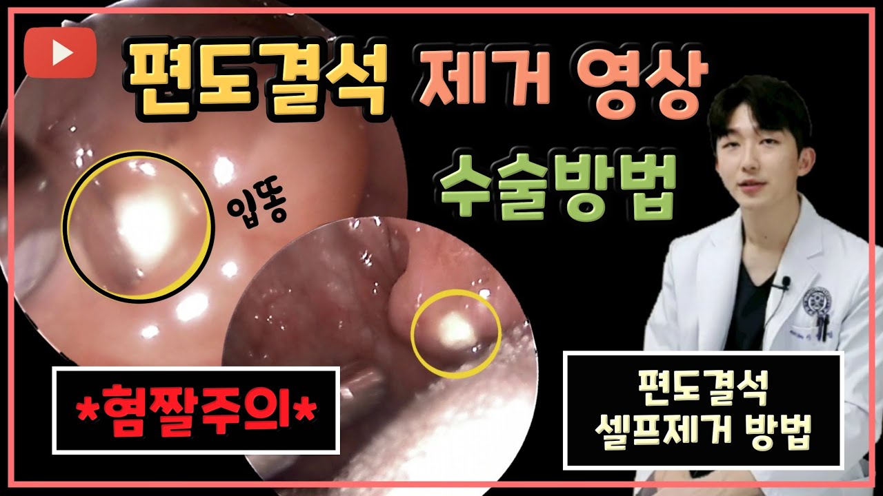 편도결석 제거기 사용, 입 냄새 해결 4 편도결석 제거기 사용, 입 냄새 해결 3