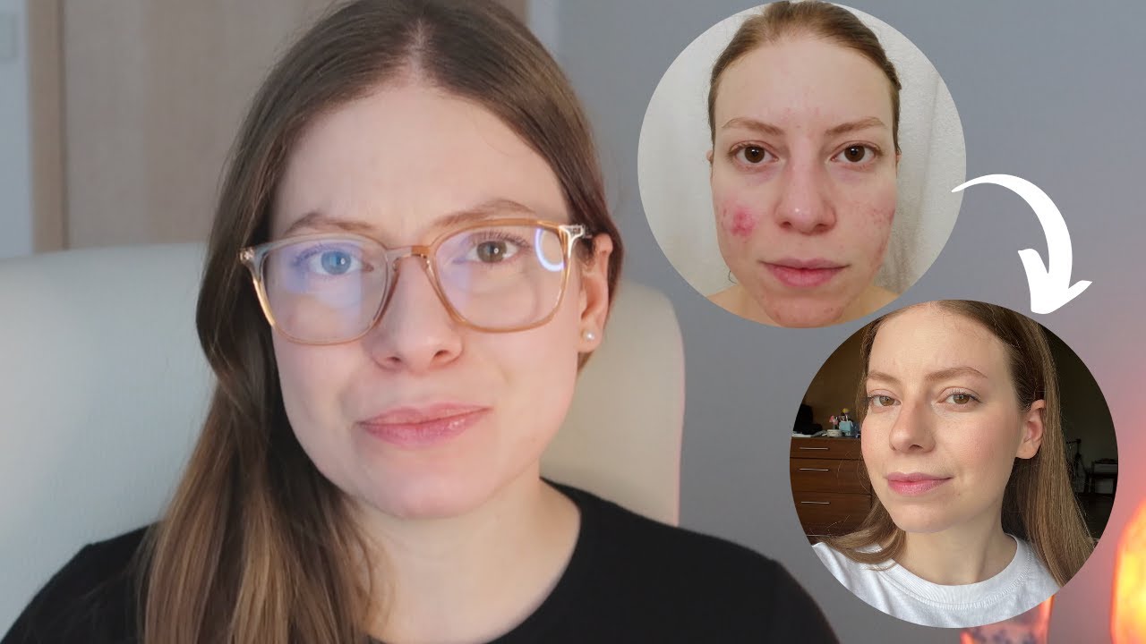 CONTROLE A ACNE ATÉ O FIM DO ANO: 5 Mudanças na Rotina de Skincare que Irão te Ajudar  ✨