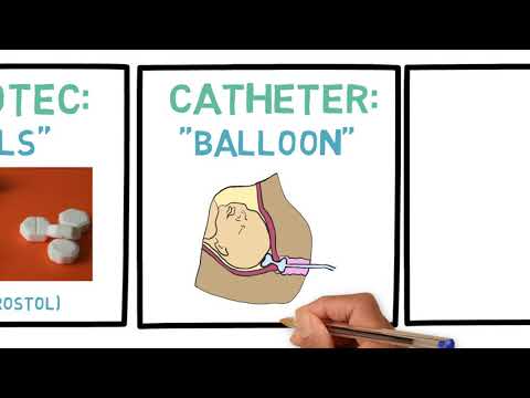 Induction of labor Video