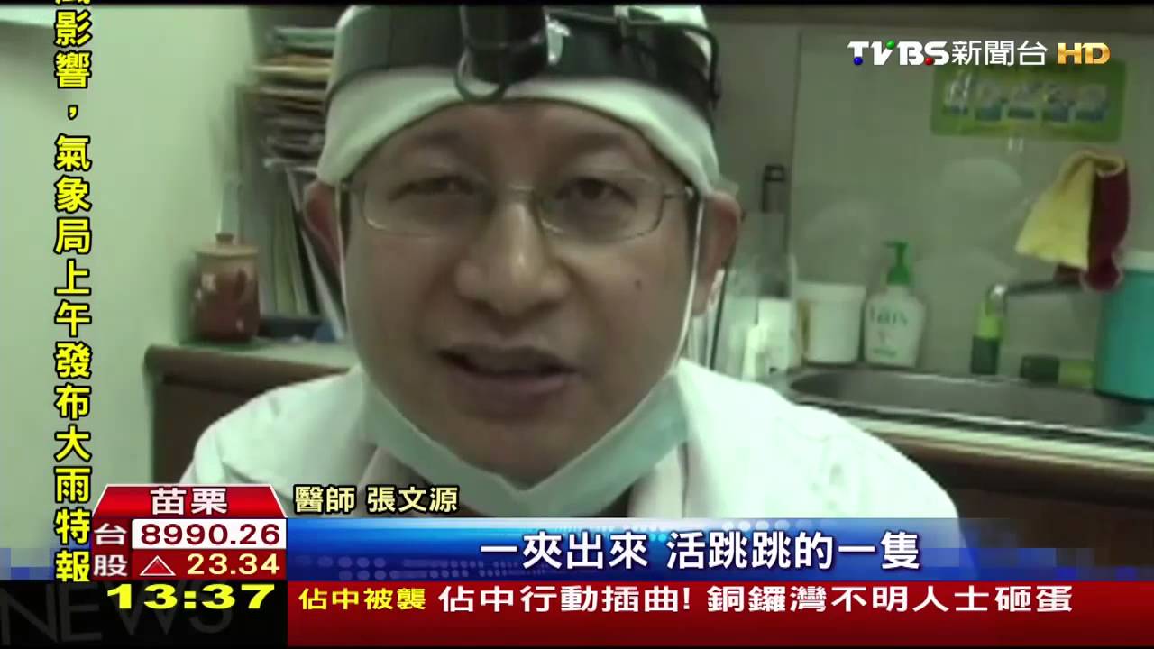 2.7cm蟋蟀「誤入」卡男外耳道 醫:罕見