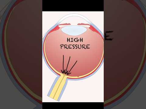 What is Glaucoma?  #glaucoma