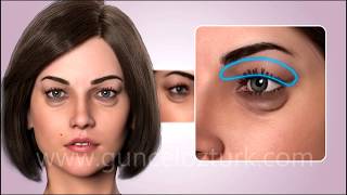 ¿Cómo se realiza las operaciónes de estética de los parpados inferior y exterior (blefaroplastia)