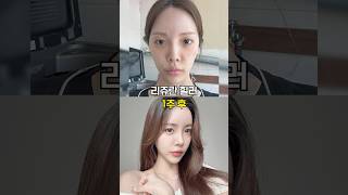 속건조 한 번에 잡은 리쥬란힐러 전후