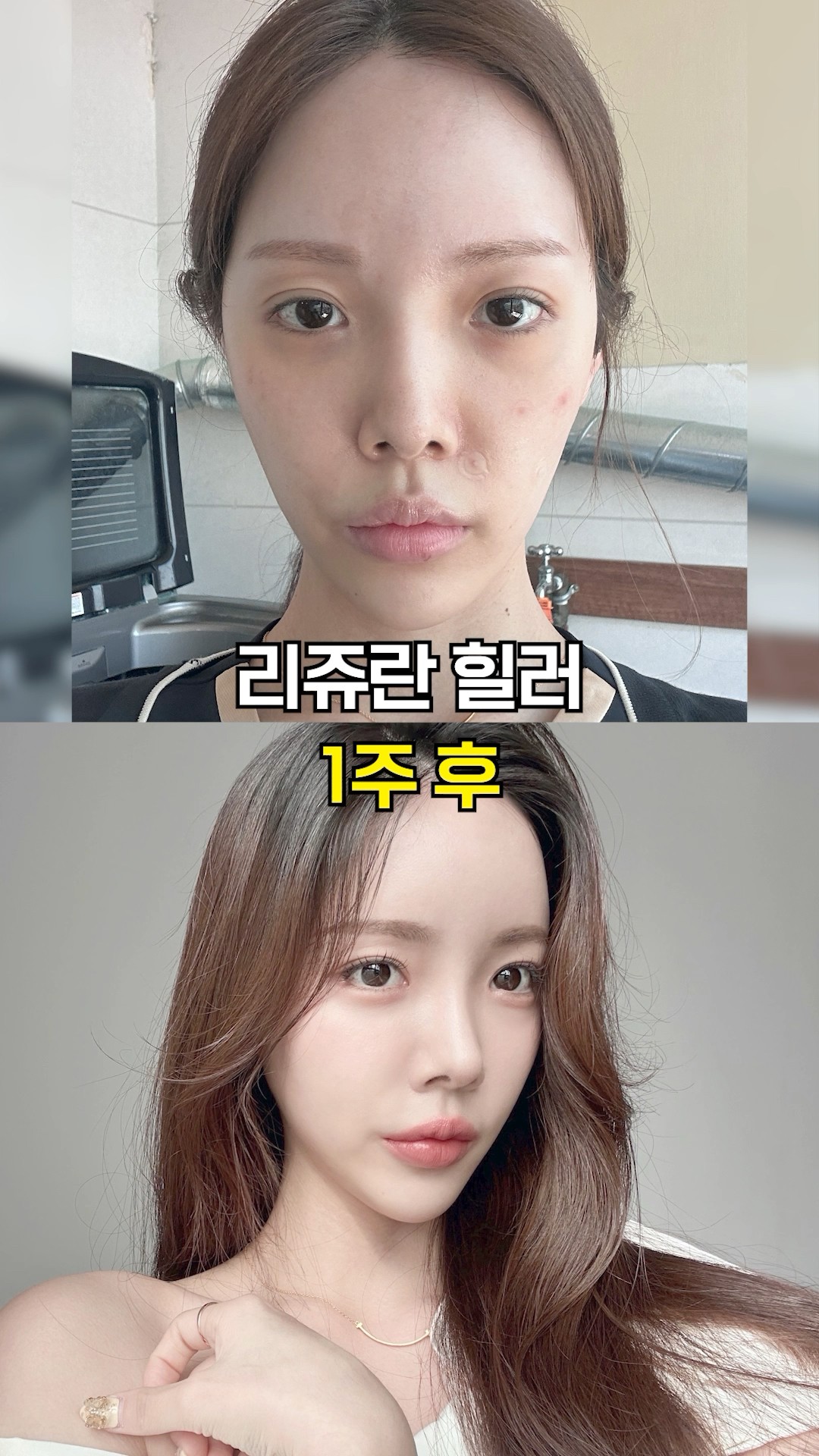 속건조 한 번에 잡은 리쥬란힐러 전후