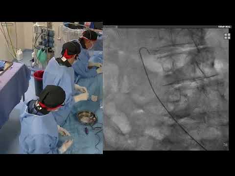 TAVI For Severe AS Using 29 MM Evolut PRO