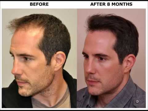 BEFORE & AFTER Hair Transplant Using ARTAS Robot for FUE