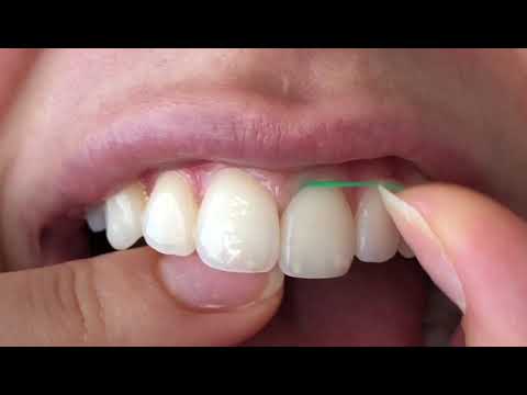 CAMPANHA DE USO CORRETO DO FIO DENTAL