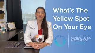 What To Do If You Have A Yellow Spot On Your Eye