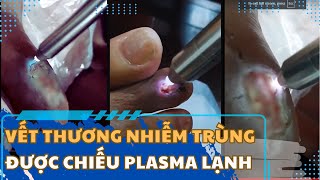 PlasmaMED: Diều trị vết thương mãn tính nhiễm trùng – kháng kháng sinh