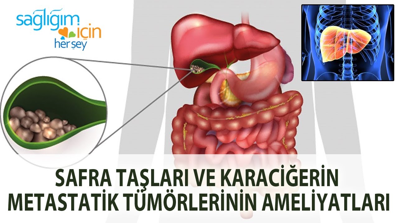 Safra Taşları ve Karaciğerin Metastatik Tümörlerinin Ameliyatları