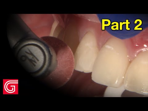 Selective Cosmetic Enameloplasty in the Anterior Teeth - Part 2