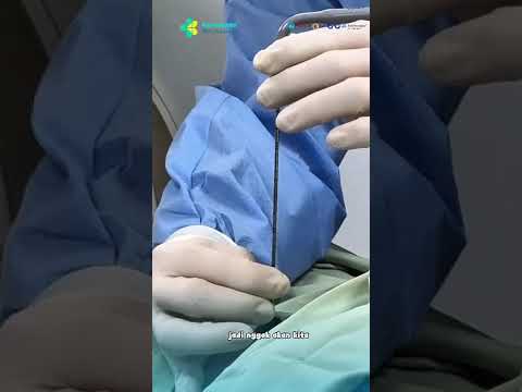 Cryoablasi untuk Penanganan Tumor Ginjal